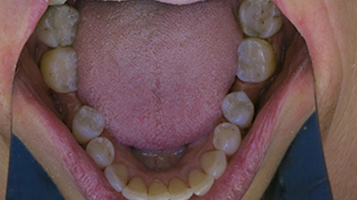 Biological Dentistry - After Treatment